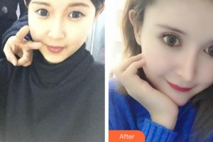 咸陽(yáng)市第一人民醫(yī)院眼科醫(yī)院趙吉飛整形價(jià)格表附眼部綜合案例展示