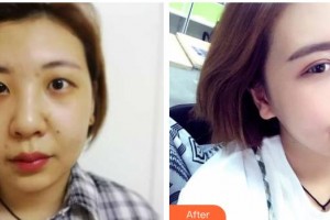 咸陽(yáng)市第一人民醫(yī)院眼科醫(yī)院馬艷整形價(jià)格表附眼部綜合案例展示