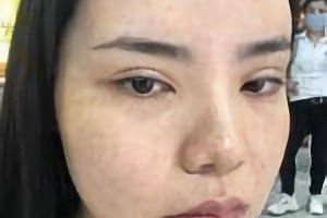 萬家燕王珍祥做下頜角怎么樣截的多嗎？附案例分享+較新價格表