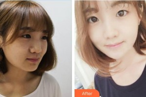 宜興品康品美醫(yī)療美容醫(yī)院丁福亮整形價格表附清潔祛痘案例展示