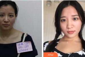 宜興韓美人醫(yī)療美容診所張鐘烈整形價格表附清潔祛痘案例展示