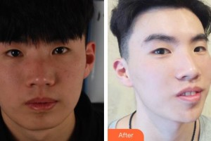 宜興市和橋醫(yī)院燒傷整形外科周松晏整形價格表附彩光嫩膚案例展示