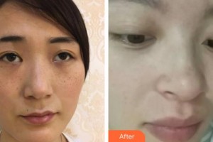 宜興市中醫(yī)院整形美容科李國春整形價格表附清潔祛痘案例展示