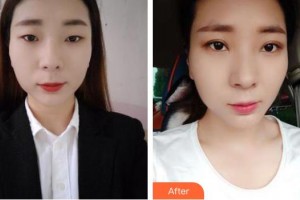 邯鄲市第七醫(yī)院整形科李九增整形價格表附激光祛斑案例展示