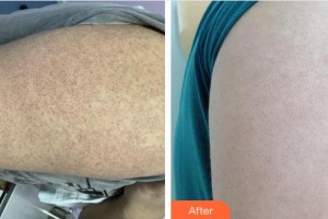 邯鄲市第七醫(yī)院整形科趙瑞艷整形價格表附清潔祛痘案例展示