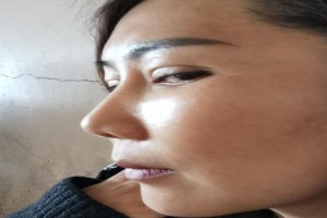 韓國一見Izien整形外科醫(yī)院金一秀輪廓修復(fù)整形果分享