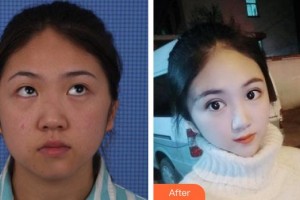 邯鄲市眼科醫(yī)院任芬花整形價格表附切開雙眼皮案例展示