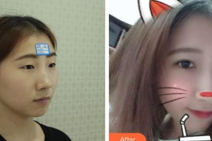 邯鄲市眼科醫(yī)院梁娜整形價格表附眼部綜合案例展示