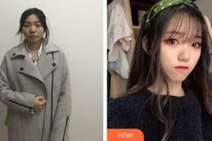 邯鄲市眼科醫(yī)院史偉整形價格表附眼部綜合案例展示