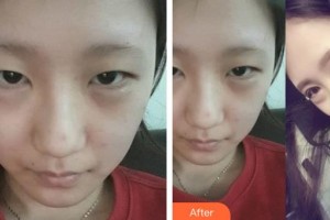 邯鄲市眼科醫(yī)院劉鐵英整形價格表附切開雙眼皮案例展示