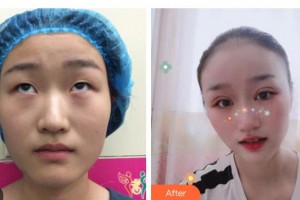 邯鄲市眼科醫(yī)院張軍明整形價格表附眼部整形雙眼皮切開雙眼皮案例展示