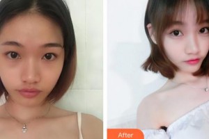 邯鄲市眼科醫(yī)院趙志強(qiáng)整形價格表附眼部綜合案例展示