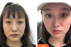 邯鄲市眼科醫(yī)院李繼英整形價格表附眼部綜合案例展示