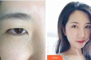 邯鄲市眼科醫(yī)院袁瑞芝整形價格表附眼部綜合案例展示