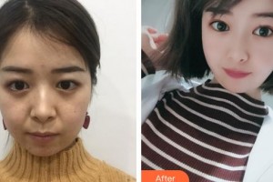 邯鄲愛眼眼科醫(yī)院高占國整形價格表附切開雙眼皮案例展示