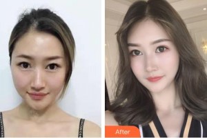 邯鄲凱潤婷整形美容醫(yī)院李靈玲整形價格表附切開雙眼皮案例展示