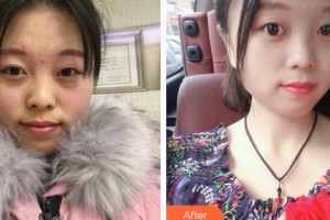 邯鄲愛爾眼科醫(yī)院張衛(wèi)華整形價格表附眼部綜合案例展示