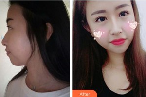 邯鄲愛爾眼科醫(yī)院李冀整形價格表附眼部綜合案例展示