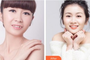 邯鄲貝潔口腔醫(yī)院張利衡整形價格表附牙齒矯正案例展示