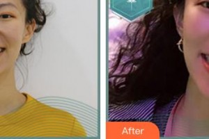 邯鄲貝潔口腔醫(yī)院史超整形價格表附隱形托槽矯正案例展示