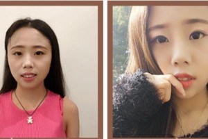 懷化市第一人民醫(yī)院尹榮林整形價(jià)格表附牙齒隱形矯正案例展示