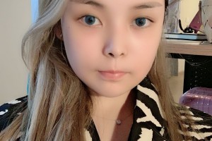 暨南大學附屬深圳華僑醫(yī)院顴骨手術(shù)附果圖