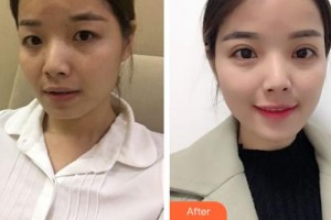 深圳市眼科醫(yī)院陳璐整形價(jià)格表附切開雙眼皮案例展示