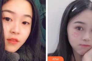 深圳市眼科醫(yī)院賀溫玲整形價(jià)格表附切開雙眼皮案例展示