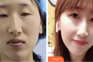 深圳市眼科醫(yī)院孫良南整形價(jià)格表附眼部綜合案例展示