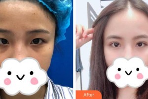 深圳華夏眼科醫(yī)院孫同整形價(jià)格表附切開雙眼皮案例展示