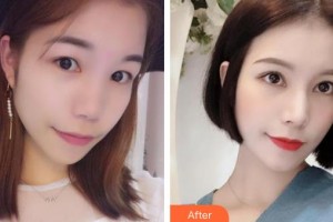 深圳華夏眼科醫(yī)院趙鐵英整形價(jià)格表附內(nèi)切祛眼袋案例展示