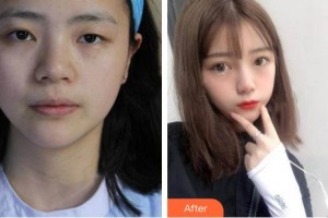 深圳市眼科醫(yī)院胡憶群整形價(jià)格表附切開雙眼皮案例展示