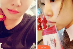 深圳市眼科醫(yī)院張國明整形價(jià)格表附切開雙眼皮案例展示