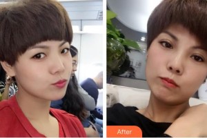 深圳市眼科醫(yī)院陳懿整形價(jià)格表附切開雙眼皮 案例展示