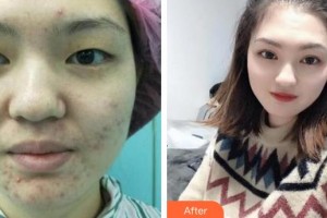 深圳?，斄猪槼毖劭漆t(yī)院林順潮整形價(jià)格表附眼部綜合案例展示