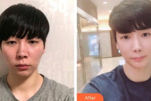 深圳愛爾眼科醫(yī)院林晨整形價(jià)格表附眼部修復(fù)案例展示