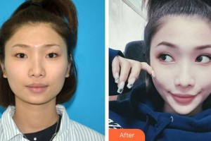 深圳愛爾眼科醫(yī)院李雙農(nóng)整形價(jià)格表附開內(nèi)眼角案例展示