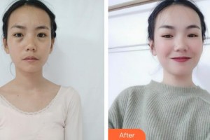 深圳愛爾眼科醫(yī)院黃麗娜整形價(jià)格表附埋線雙眼皮案例展示