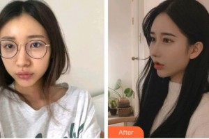 深圳愛爾眼科醫(yī)院夏娟整形價(jià)格表附內(nèi)切祛眼袋案例展示