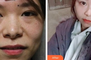 深圳愛爾眼科醫(yī)院司馬晶整形價(jià)格表附內(nèi)切祛眼袋案例展示