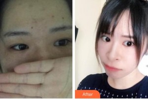 深圳愛爾眼科醫(yī)院鄧宏偉整形價(jià)格表附定點(diǎn)雙眼皮案例展示