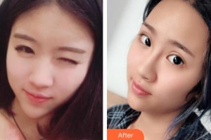 深圳愛爾眼科醫(yī)院成躍偉整形價格表附內(nèi)切祛眼袋案例展示