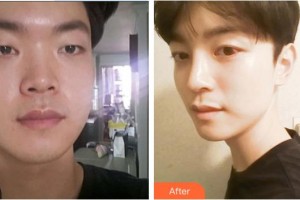 深圳愛爾眼科醫(yī)院易細香整形價格表附眼部綜合案例展示