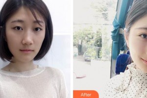 深圳愛爾眼科醫(yī)院楊化學整形價格表附定點雙眼皮案例展示