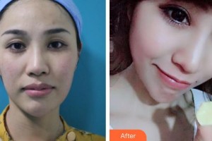 深圳愛爾眼科醫(yī)院胡珊整形價格表附眼部綜合案例展示