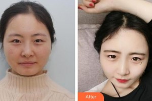 深圳?，斄猪槼毖劭漆t(yī)院肖月影整形價格表附眼部修復案例展示