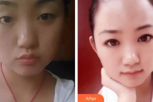 深圳希瑪林順潮眼科醫(yī)院卡夫恩整形價格表附眼部修復案例展示