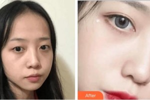 深圳?，斄猪槼毖劭漆t(yī)院哈斯爾整形價格表附切開雙眼皮案例展示