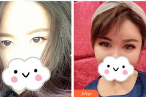 深圳?，斄猪槼毖劭漆t(yī)院劉泉整形價格表附眼部綜合案例展示