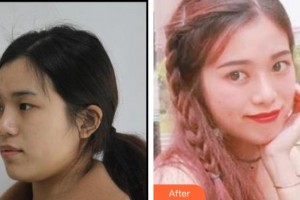 深圳?，斄猪槼毖劭漆t(yī)院尉洋整形價格表附眼部綜合案例展示